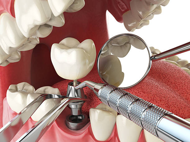 Best Emergency Dental Extractions in Flint Hill, MO